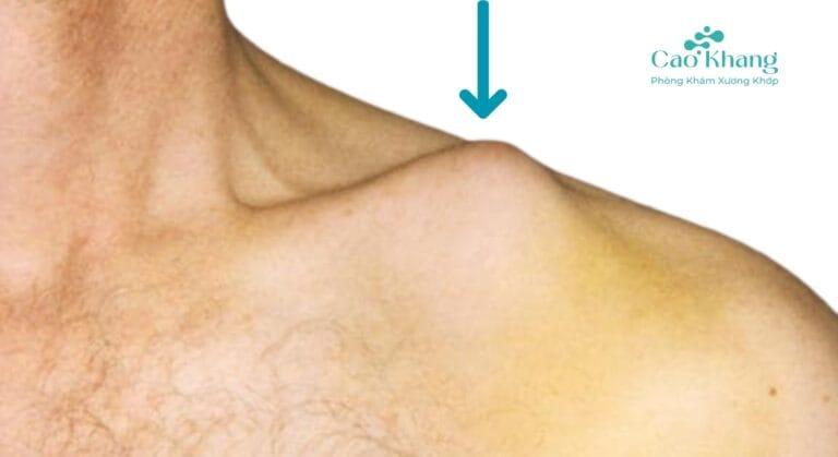 gãy xương đòn bao lâu thì lành