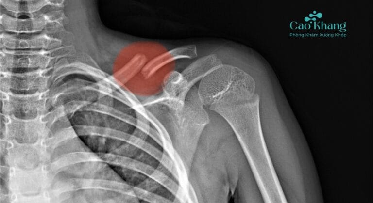 gãy xương đòn (xương quai xanh)