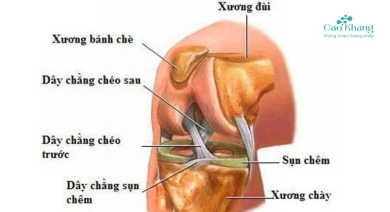giãn dây chằng