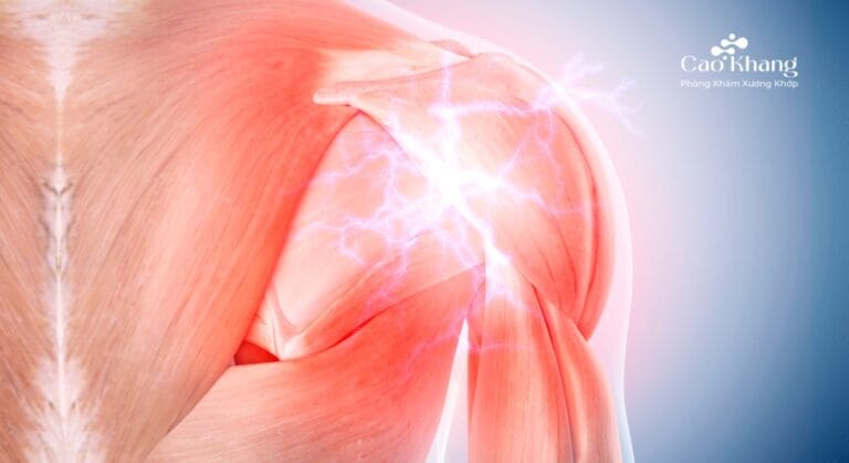 giãn dây chằng vai