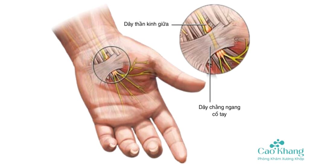 nguyên nhân hội chứng đường hầm cổ tay