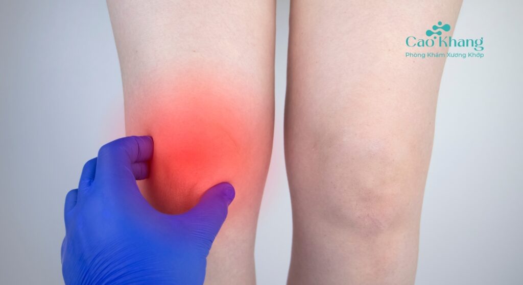 sưng do giãn dây chằng đầu gối