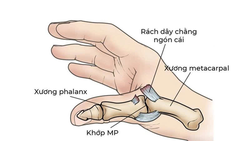 trật khớp ngón cái