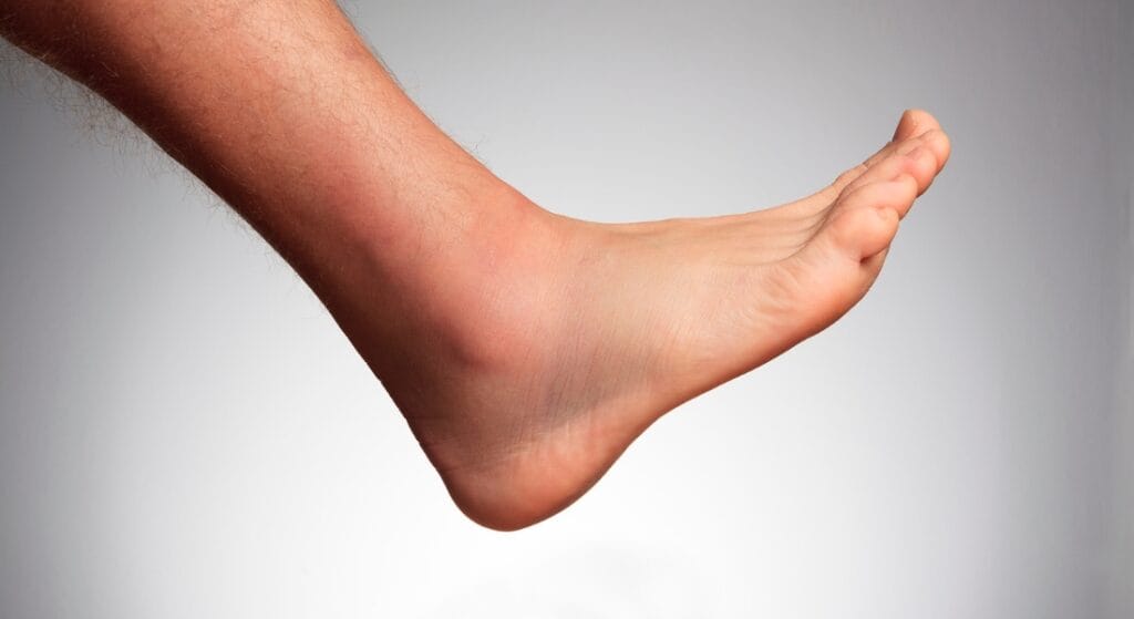 Đau nhức chỗ gãy xương