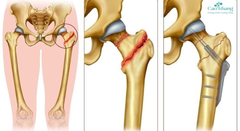 Gãy liên mấu chuyển xương đùi