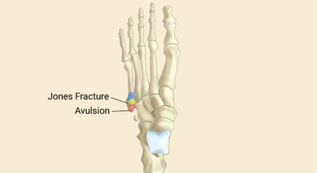 Jones & Avulsion