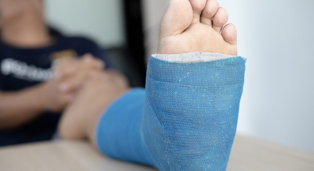 bó bột gãy xương bàn chân số 5