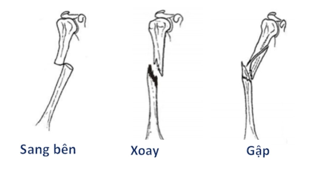 các loại di lệch gãy xương