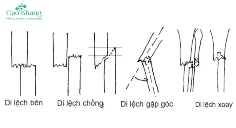 các loại di lệch trong gãy xương