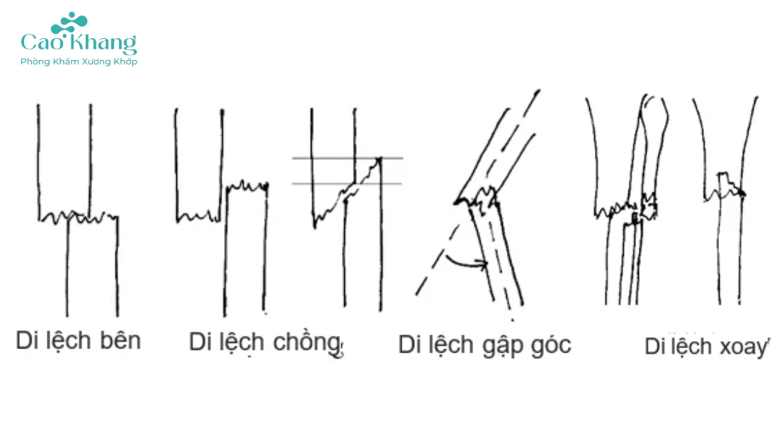 các loại di lệch trong gãy xương