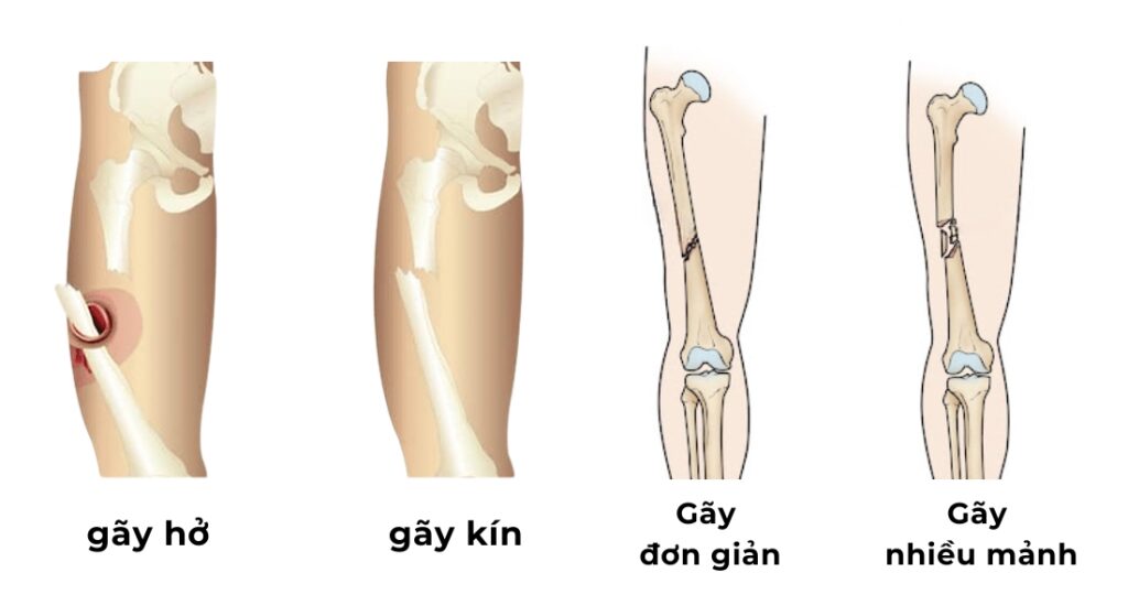 các loại gãy xương đùi