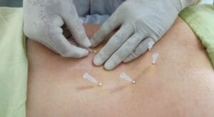 cấy chỉ chữa thoát vị đĩa đệm