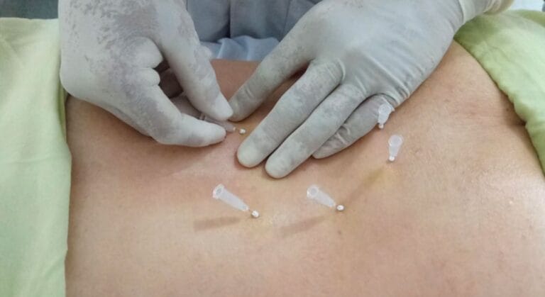 cấy chỉ chữa thoát vị đĩa đệm