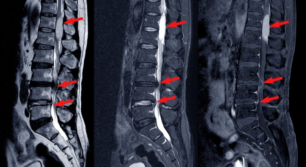 chuẩn đoán hẹp ống sống bằng MRI