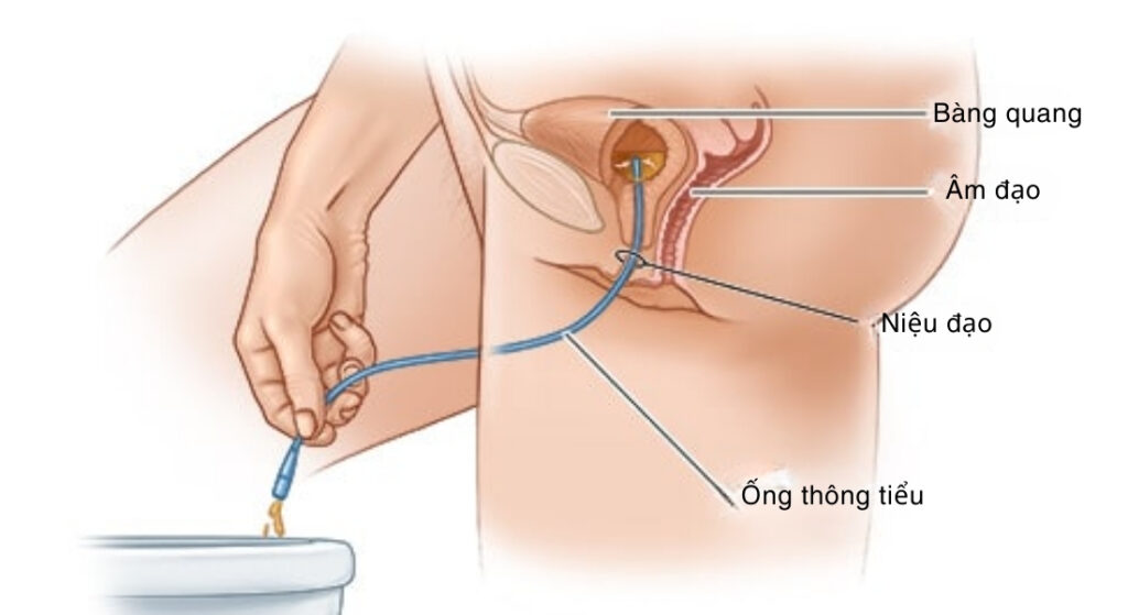 đặt ống thông tiểu