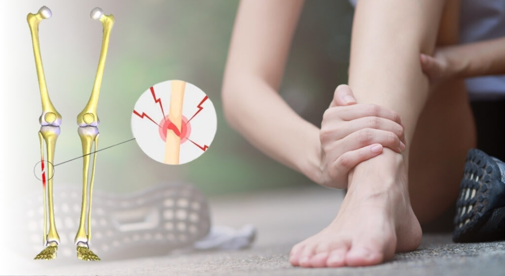 dấu hiệu gãy xương mác