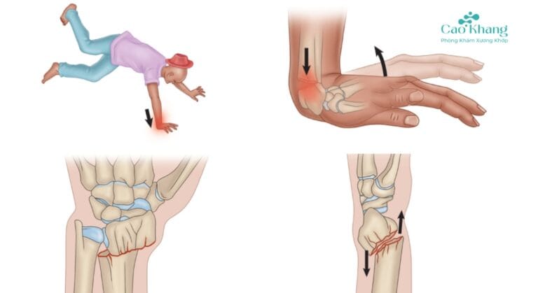 gãy đầu dưới xương quay là gì