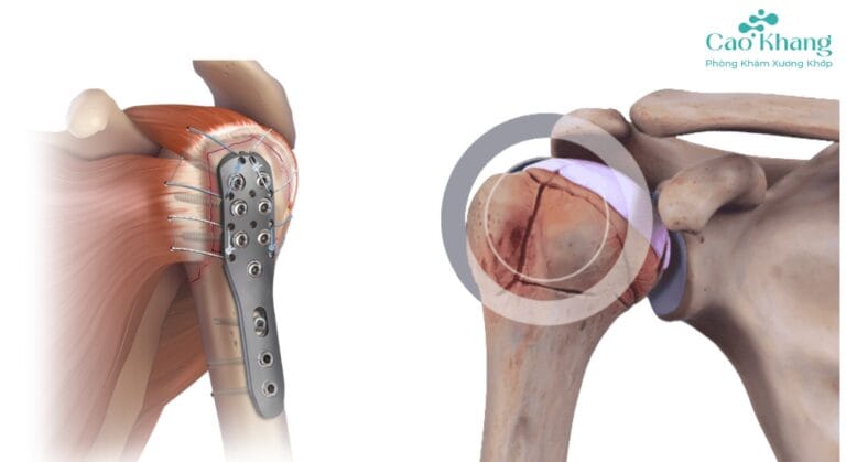 gãy đầu trên xương cánh tay