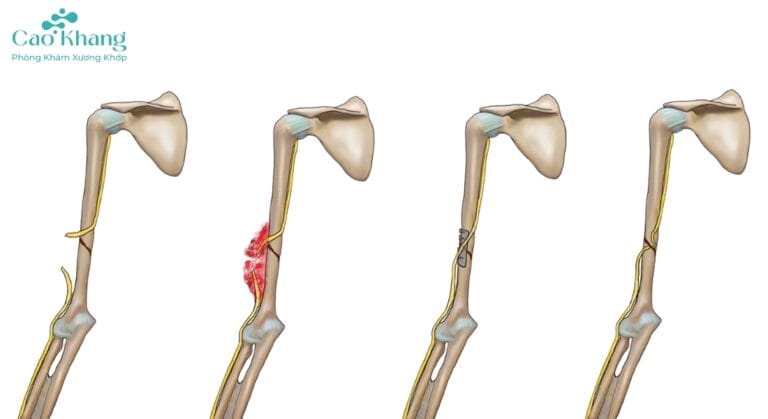gãy thân xương cánh tay