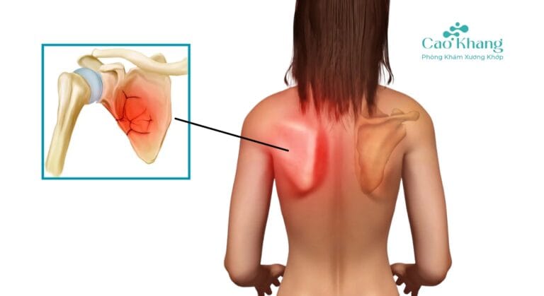 gãy xương bả vai