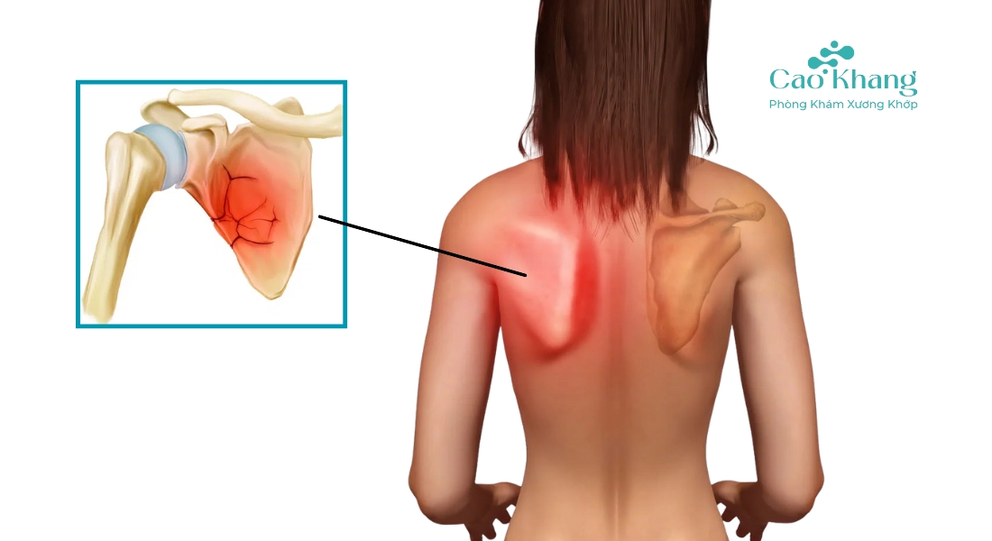 gãy xương bả vai