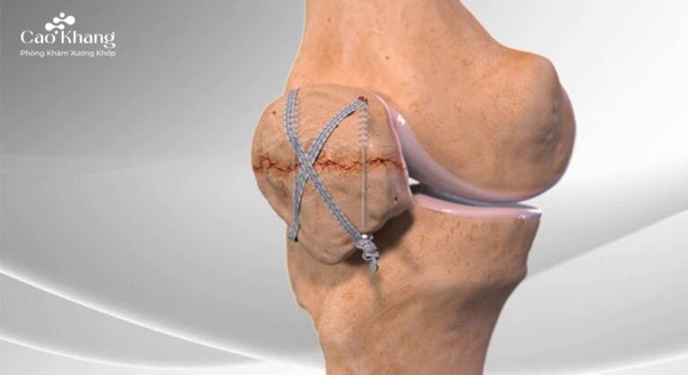 gãy xương bánh chè