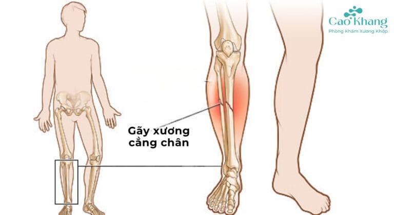 gãy xương cẳng chân