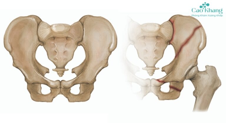 gãy xương chậu