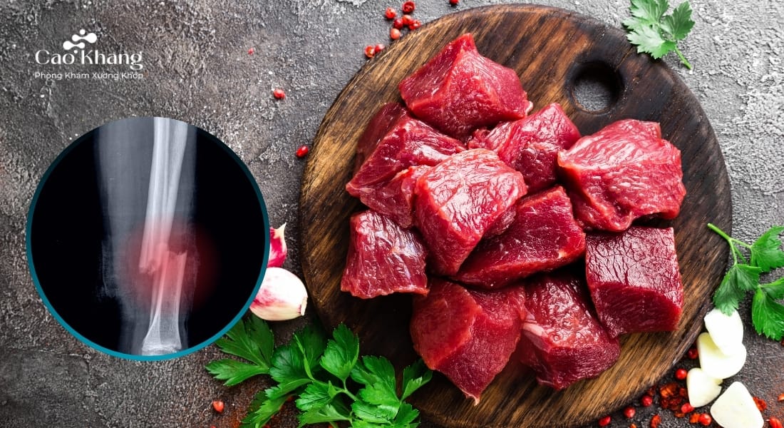 gãy xương có nên ăn thịt bò không