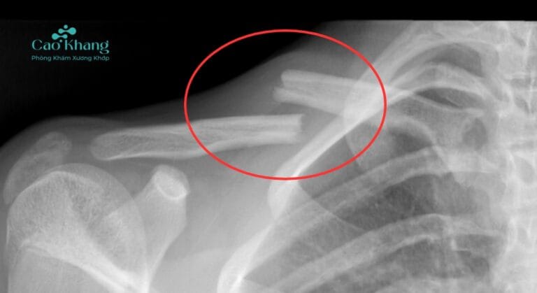 gãy xương đòn di lệch