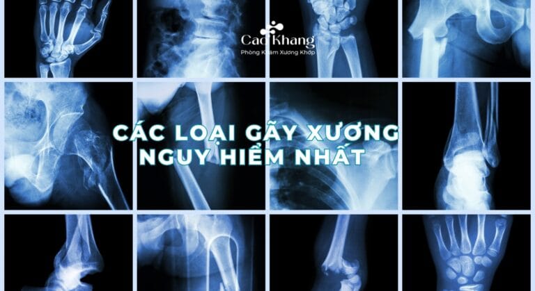 gãy xương nào nguy hiểm nhất