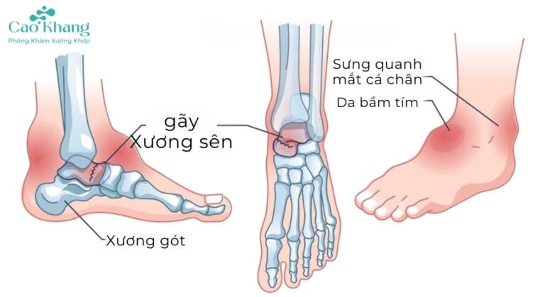 gãy xương sên