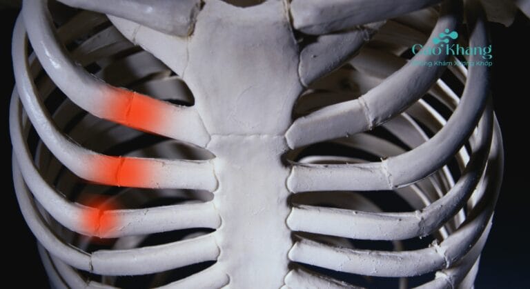 gãy xương sườn bao lâu thì lành