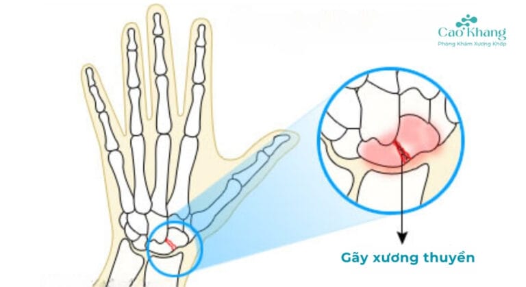 gãy xương thuyền cổ tay