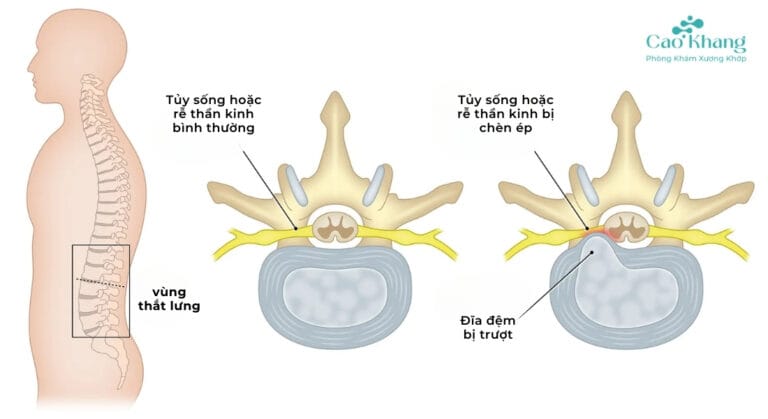 hẹp ống sống thắt lưng