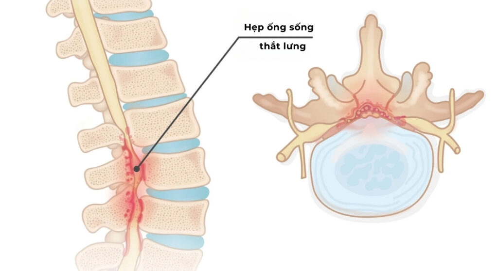 hẹp ống sống thắt lưng là gì