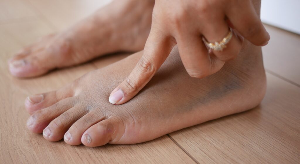 nguyên nhân chỗ gãy xương bị sưng