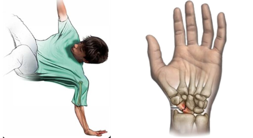 nguyên nhân gãy xương thuyền cổ tay