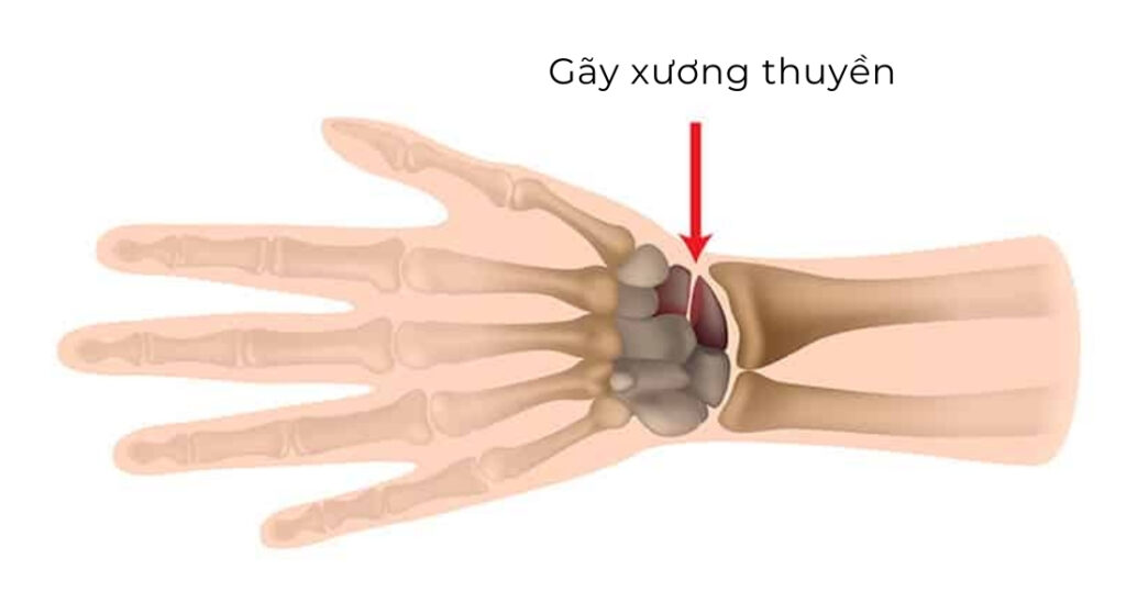 nhận biết gãy xương thuyền