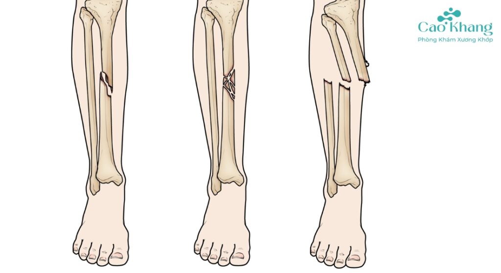 phân loại gãy xương cẳng chân