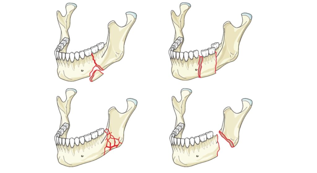 phân loại gãy xương hàm dưới