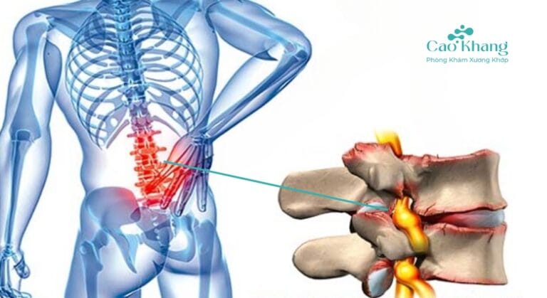thoái hóa cột sống thắt lưng