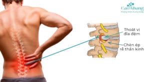 thoát vị đĩa đệm chèn dây thần kinh