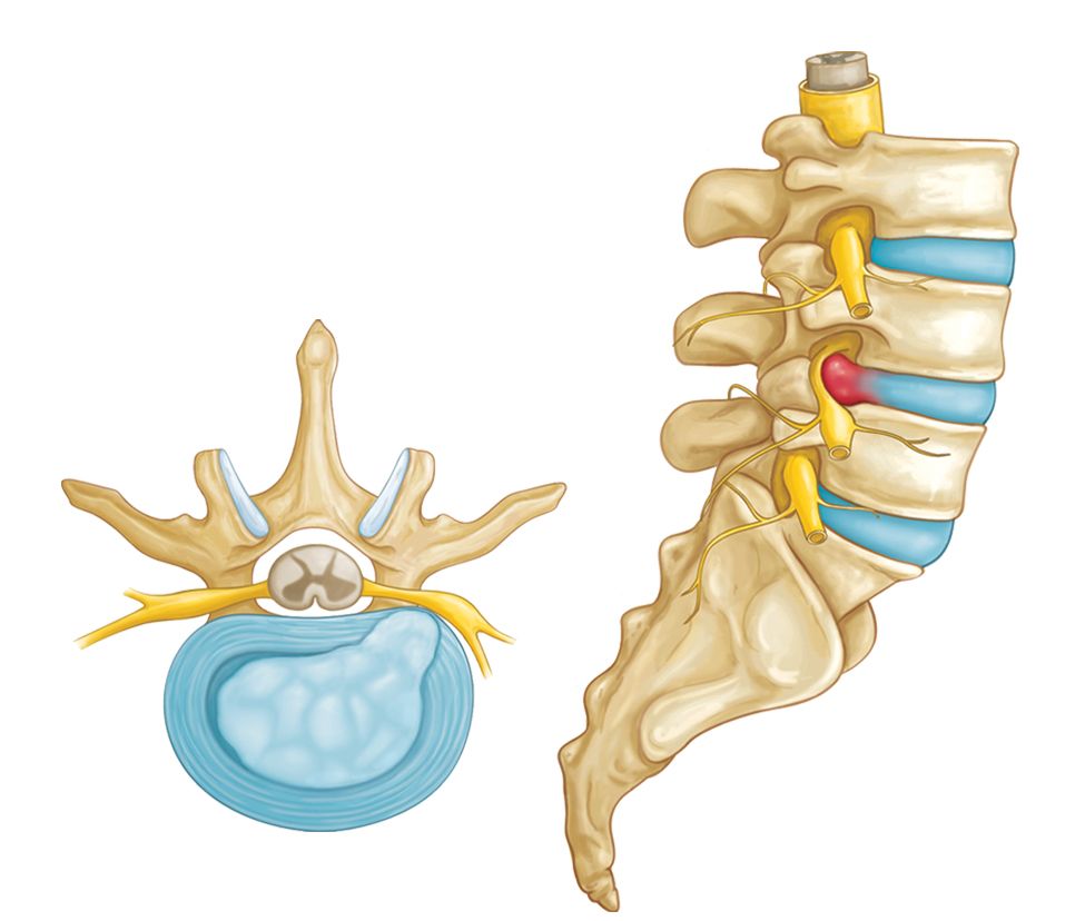 thoát vị đĩa đệm chèn dây thần kinh