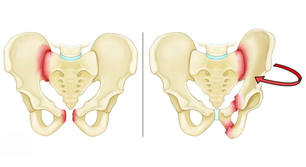 triệu chứng gãy xương chậu