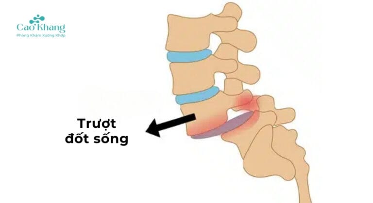 trượt đống sống