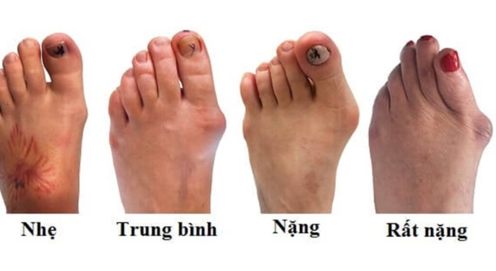 Hạt tophi nguy hiểm như thế nào