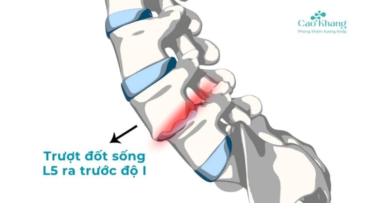 Trượt đốt sống L5 ra trước độ 1