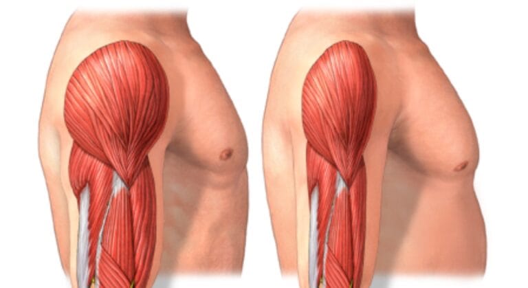 bệnh teo cơ có chữa được không