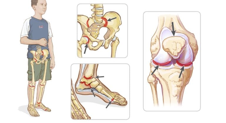 bệnh viêm khớp thiếu niên